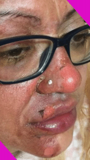 A Woman's Mouth Got Burnt, She Was Making Eggs By Taking Instructions From The Internet