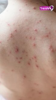 How To Identify the initial symptoms of chicken pox? - Short Video