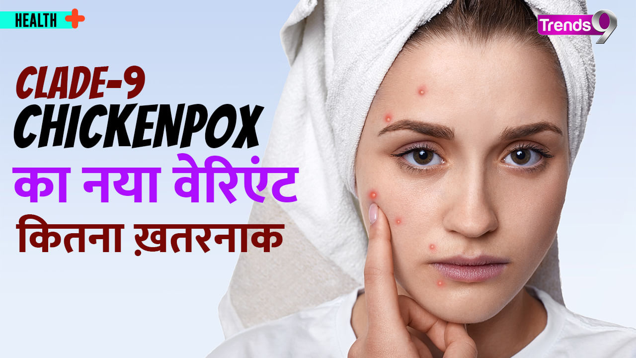 How dangerous is Chicken Pox? Learn How to Avoid This From Dr. Swati